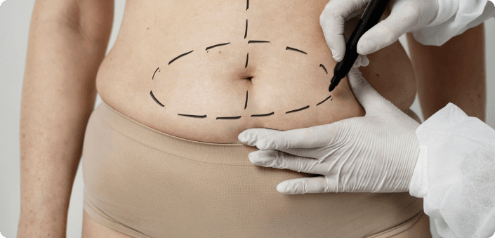 Bariatric Surgery