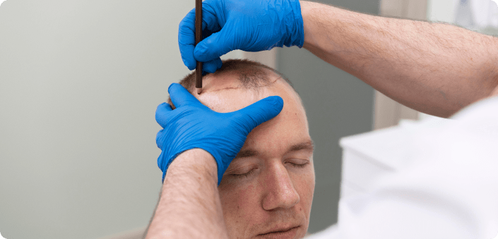 Hair Transplantation